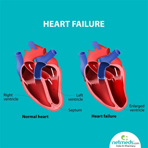 mild lv systolic dysfunction means|decreased left ventricular systolic function.